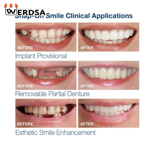 لمینت متحرک دندان دو فک snap on smile