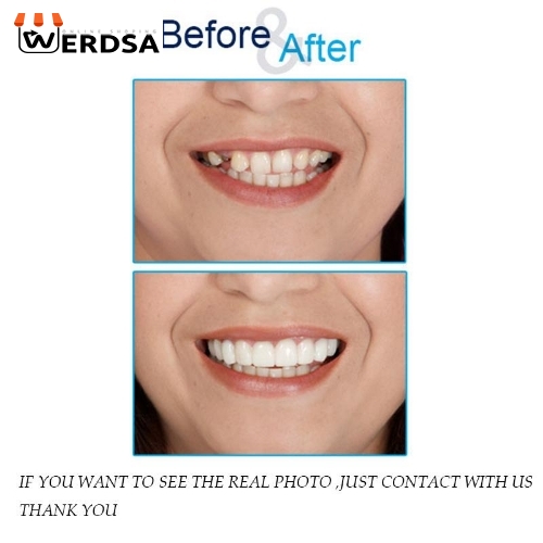 لمینت متحرک دندان دو فک snap on smile شرکتی اصلی