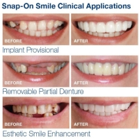 لمینت متحرک دندان دو فک snap on smile کد 1497 شرکتی اصلی