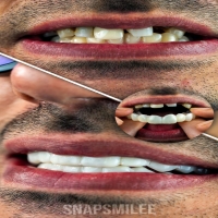 خمیر اسنپ آن اسمایل دو فک بدون قالب