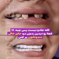 لمینت دندان snap on smile برای خرابی 4 دندان